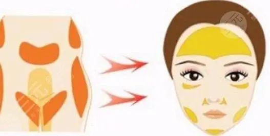 拉皮手术的麻醉方式有哪些？有几种需要全麻吗医生医院咨询(图2)