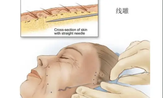九游娱乐文化：40+想要“显年轻”收藏这份面部抗衰项目合集你会用得到！(图4)