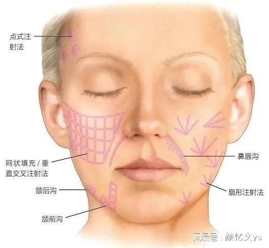 九游娱乐文化：微整医生颜忆文：探讨童颜针（PLLC）注射技巧及注射层次(图2)