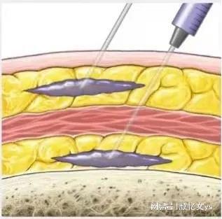 九游娱乐文化：微整医生颜忆文：探讨童颜针（PLLC）注射技巧及注射层次(图3)